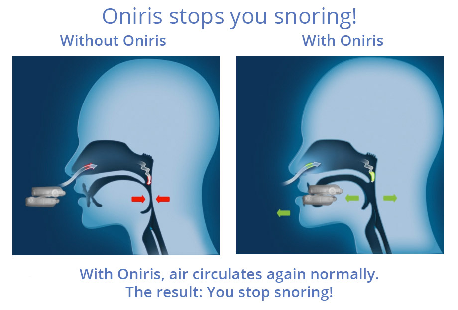 With-and-without-ONIRIS